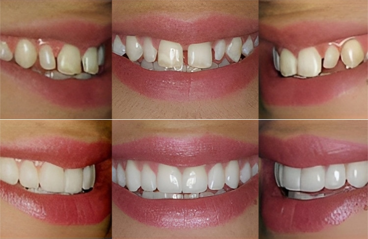 Before and after comparison of smile transformations showing teeth whitening and cosmetic dental improvements.