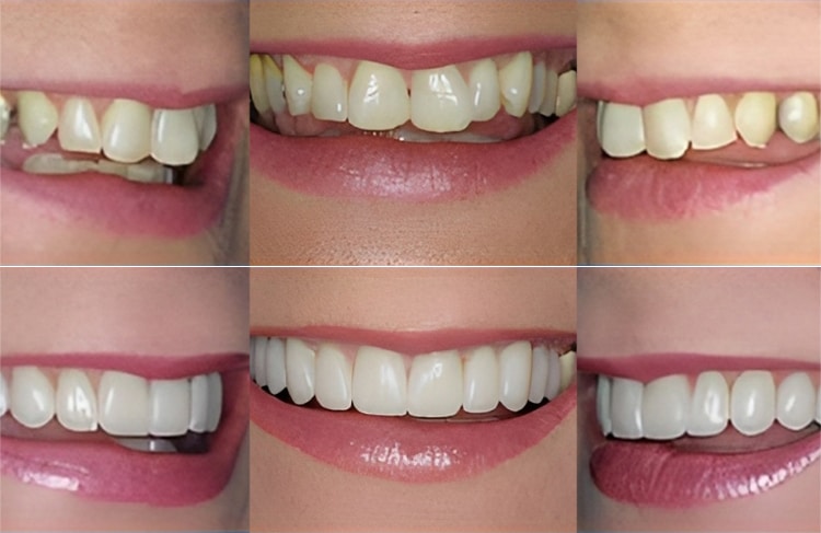 Six close-up views of different smiles showing teeth whitening and cosmetic dental results.