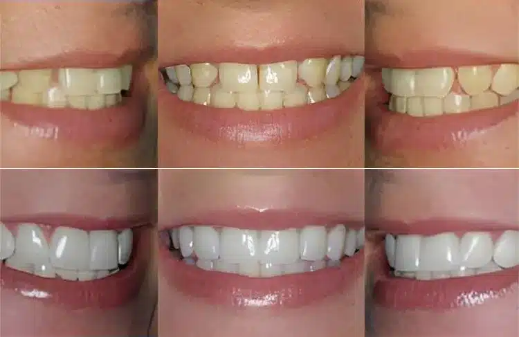 Before and after dental treatment results showing tooth whitening and cosmetic improvements.