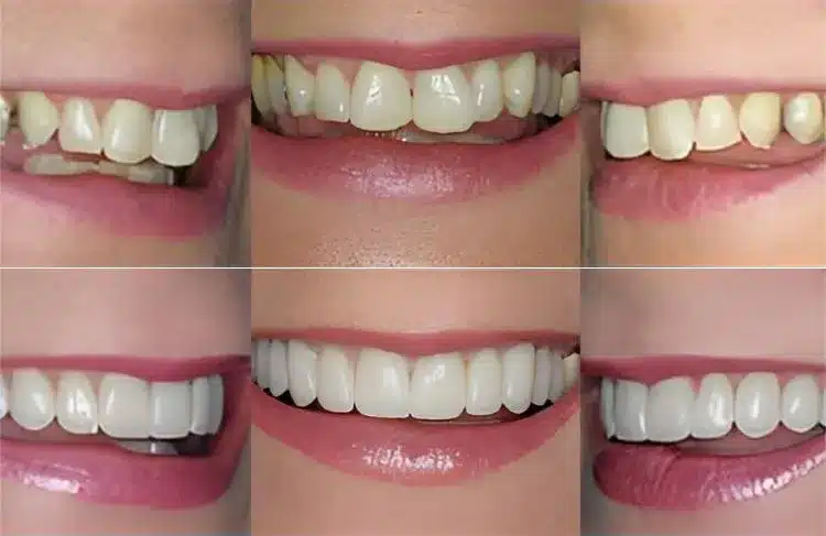 Six close-up views of different smiles displaying various teeth whitening and cosmetic dental results.