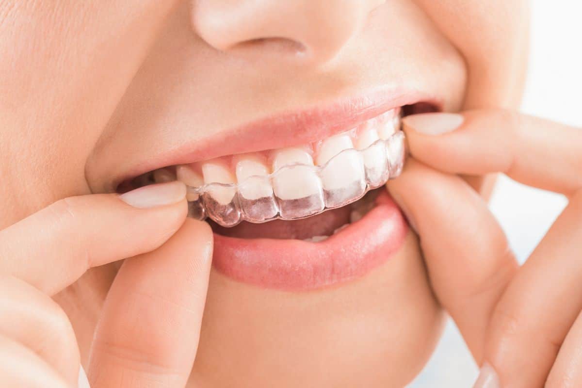 Invisalign Fort Wayne IN at Family Dentistry & Aesthetics