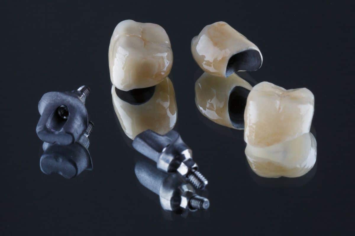 Dental Crown Fort Wayne IN at Family Dentistry