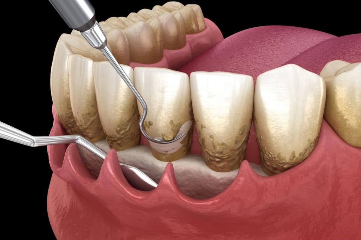 The Hidden Dangers of Ignoring Bacterial Mouth Infections in Fort Wayne, IN at Family Dentistry