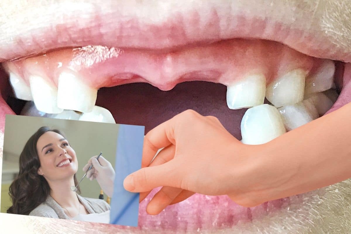 The Best Ways to Repair Severe Front Tooth Damage