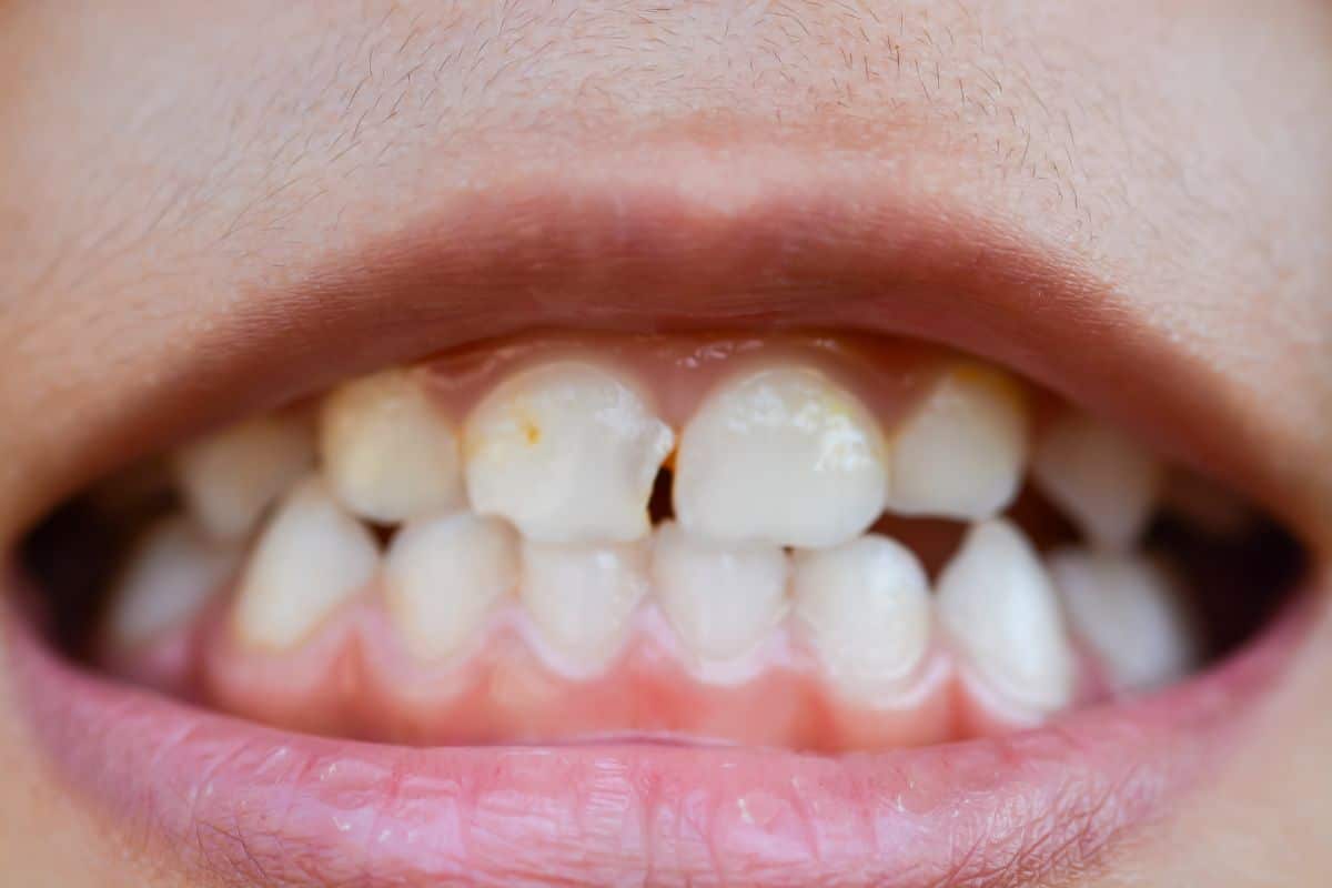 dental enamel erosion home care - Family Dentistry