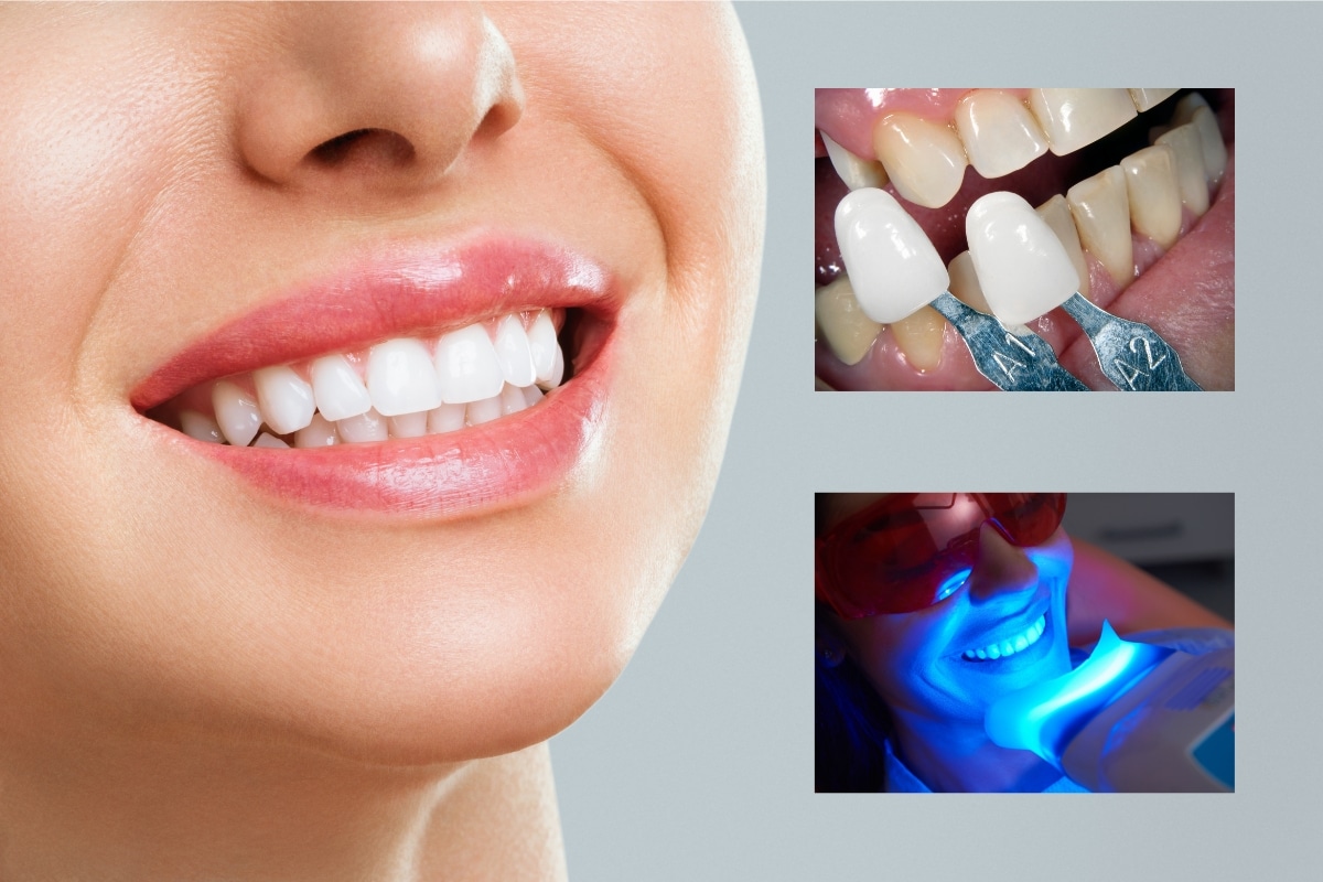 Smile Bright With Veneers or Teeth Whitening in Fort Wayne IN at Family Dentistry & Aesthetics