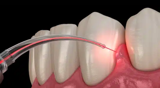Dental laser treatment on gum tissue near tooth surface, demonstrating periodontal therapy procedure.