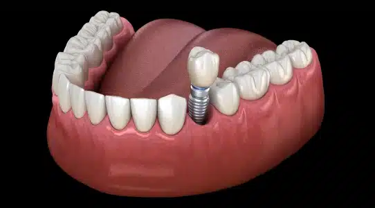 Dental implant model showing artificial tooth replacement in gum tissue against black background.
