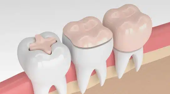 Progression of dental crown placement on tooth model showing stages from tooth preparation to final restoration.