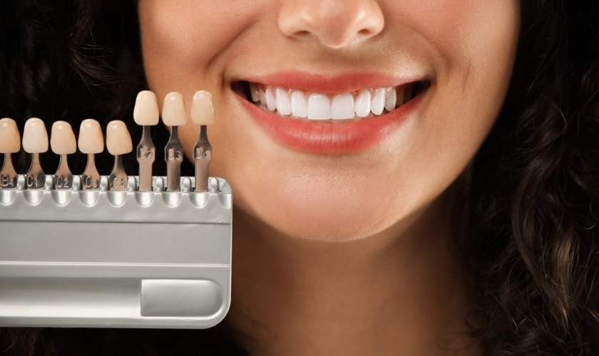 Veneers Before After