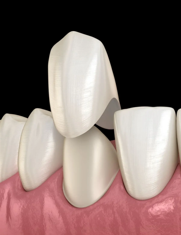 Perfect Smile with Customized Dental Crowns In Fort Wayne