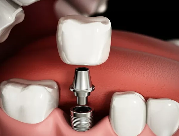 Restore Your Missing Teeth With Dental Implants in fort wayne
